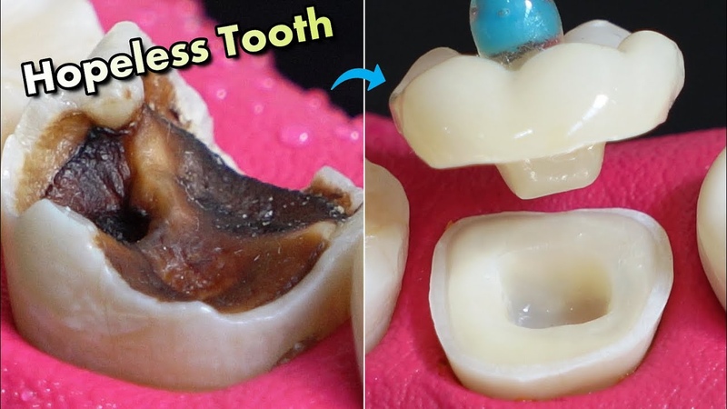 IMPOSSIBLE Restoration Of Tooth Caries Amazing Before And